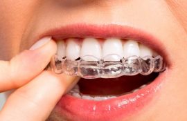 Для чего и в каких случаях ставят капы для зубов