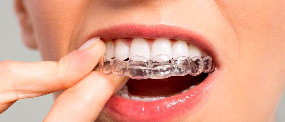 Для чего и в каких случаях ставят капы для зубов