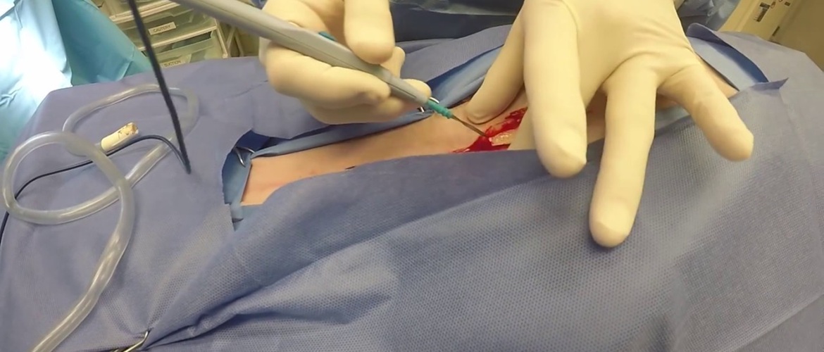 Обладнання для електрохірургії – як обрати якісні вироби для медичних маніпуляцій